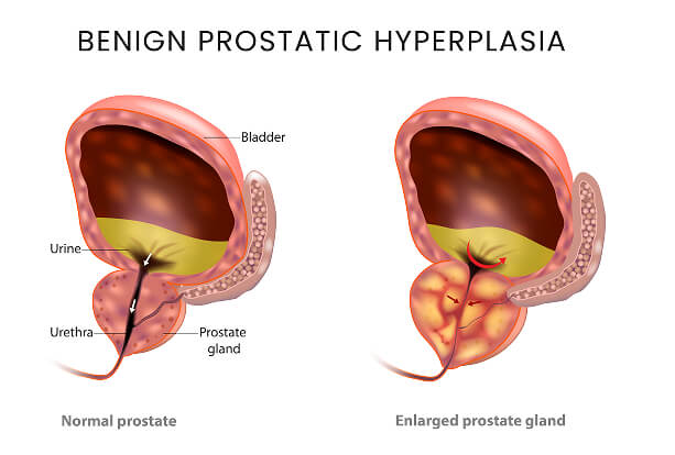 Benign Prostatic Hyperplasia